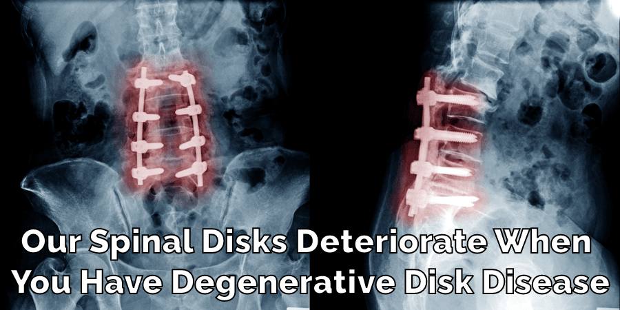 Our Spinal Disks Deteriorate When 
You Have Degenerative Disk Disease